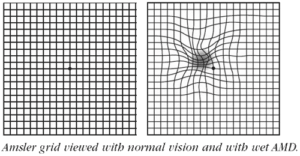 Age-Related Macular Degeneration (AMD) Detroit Michigan