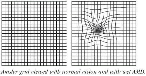 Central Vision and Hearing - This Amsler Grid can help aid in the detection  of Age-Related Macular Degeneration. AMD can cause central vision blurring,  and is not always noticeable. This is why